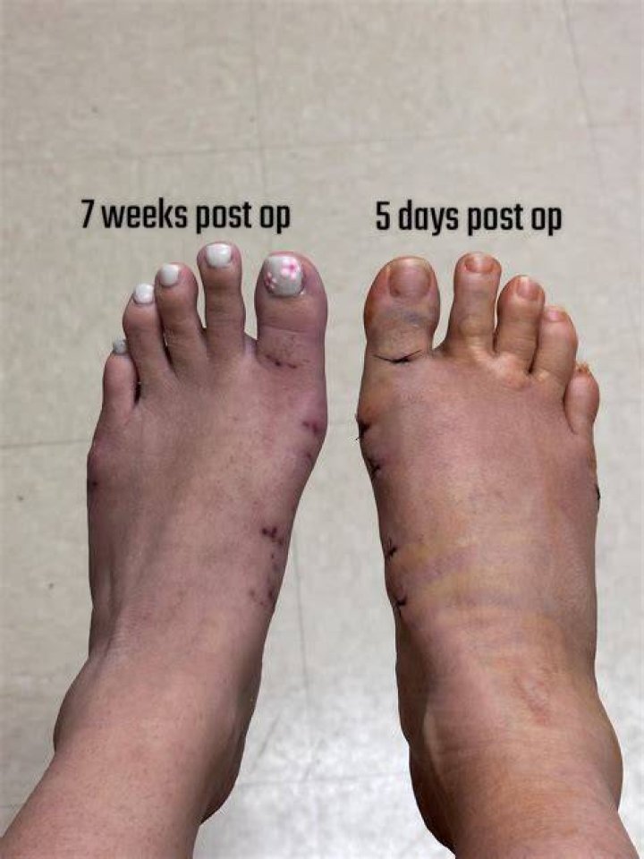 Can I walk 3 weeks after bunion surgery?
