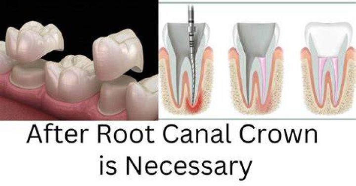 Is it necessary to put crown after root canal?