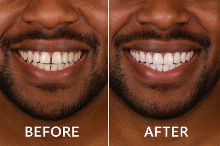 Should I whiten teeth before veneers?