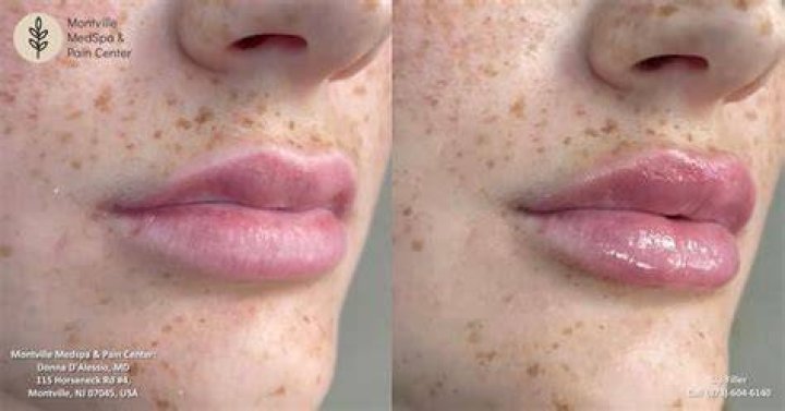 What happens if you drink from a straw after lip filler?